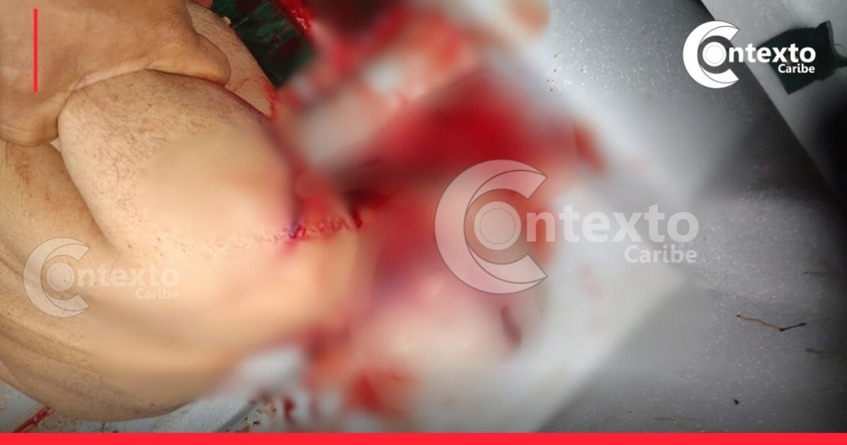 Imágenes muestran la gravedad del accidente de turista italiano en Cartagena golpeado por la hélice de una lancha